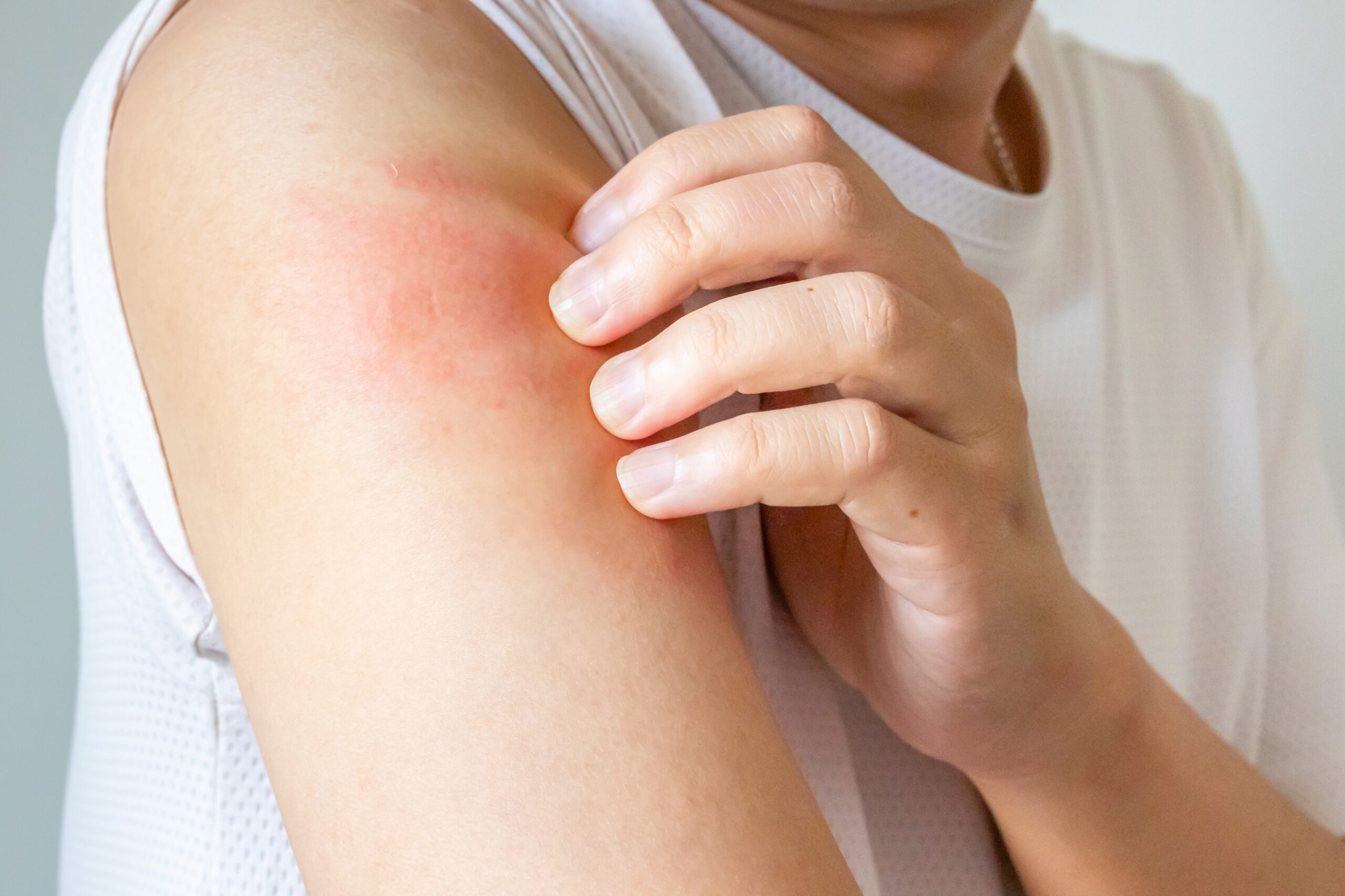 Young,asian,man,itching,and,scratching,on,arm,from,allergic